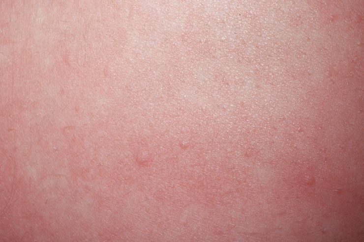 http://hyewonclinic.com/xe/1798 두드러기 정보