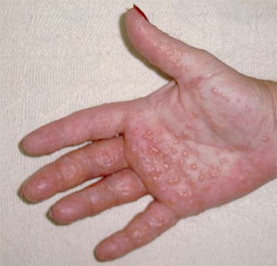 http://hyewonclinic.com/xe/?mid=Etc_Skin_Info&category=3767&document_srl=4129 피부사전