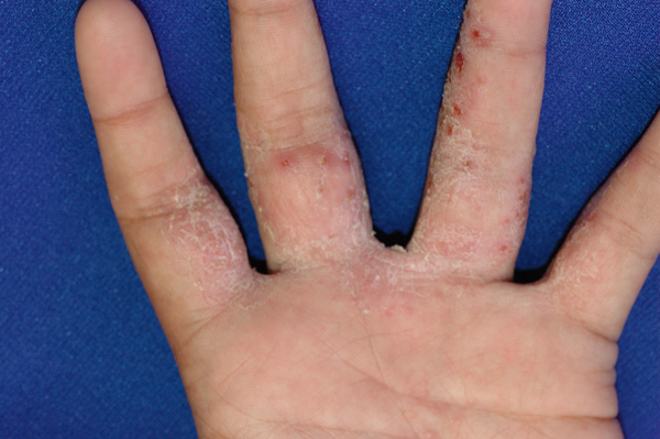 What Is The Difference Between Dyshidrotic Eczema And