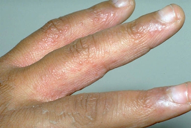 http://hyewonclinic.com/xe/?mid=Etc_Skin_Info&category=3767&document_srl=4129 피부사전